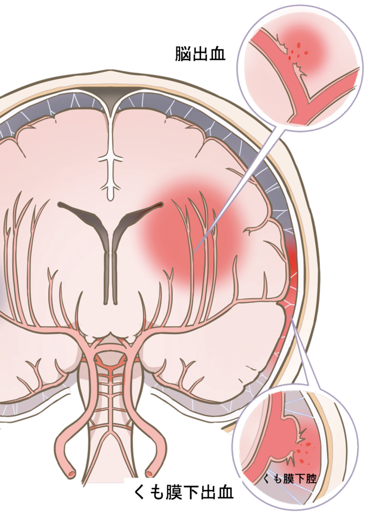 脳出血の脳の画像