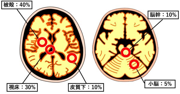 脳出血の種類の画像