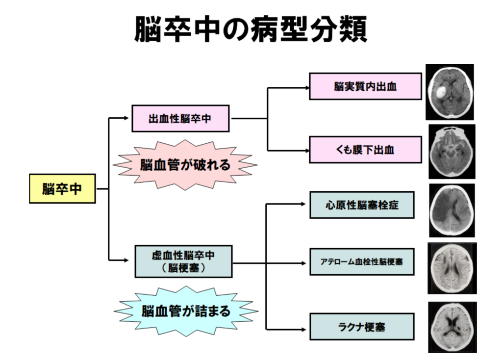 脳卒中の病型分類